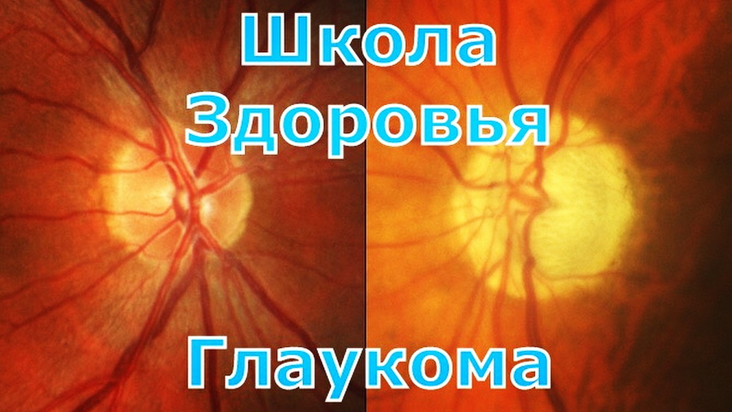 3 сентября будет проведена лекция для больных глаукомой